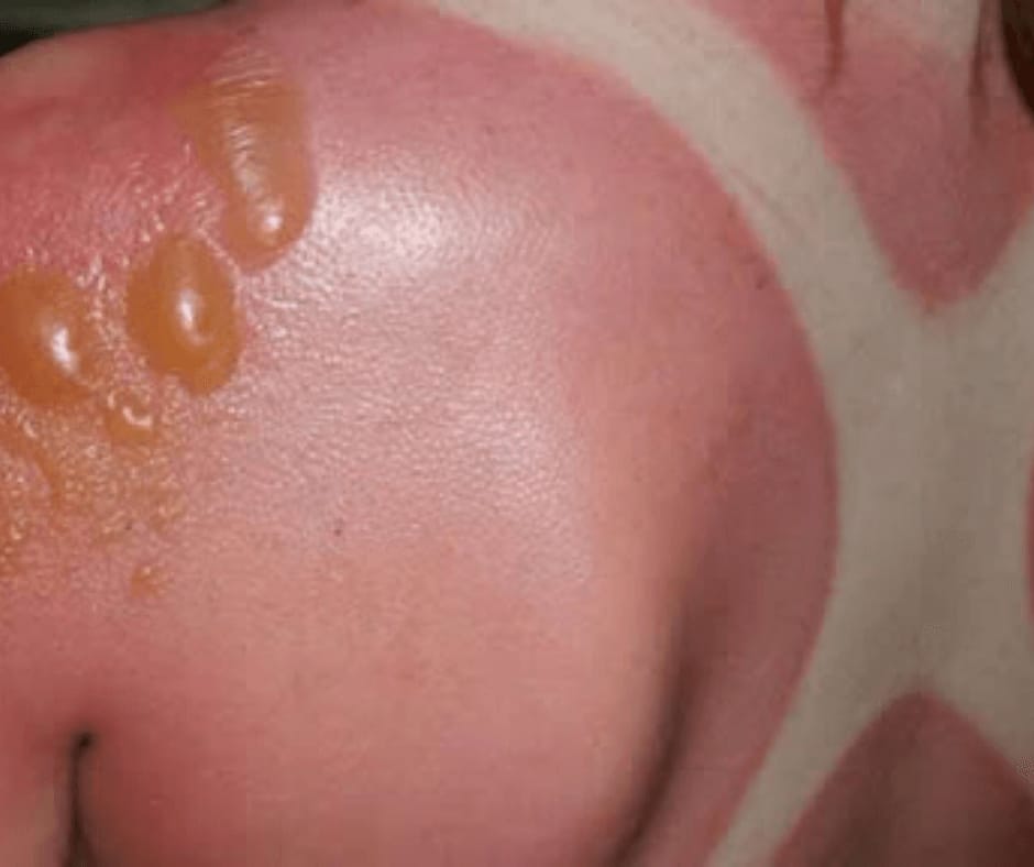 scottatura sole